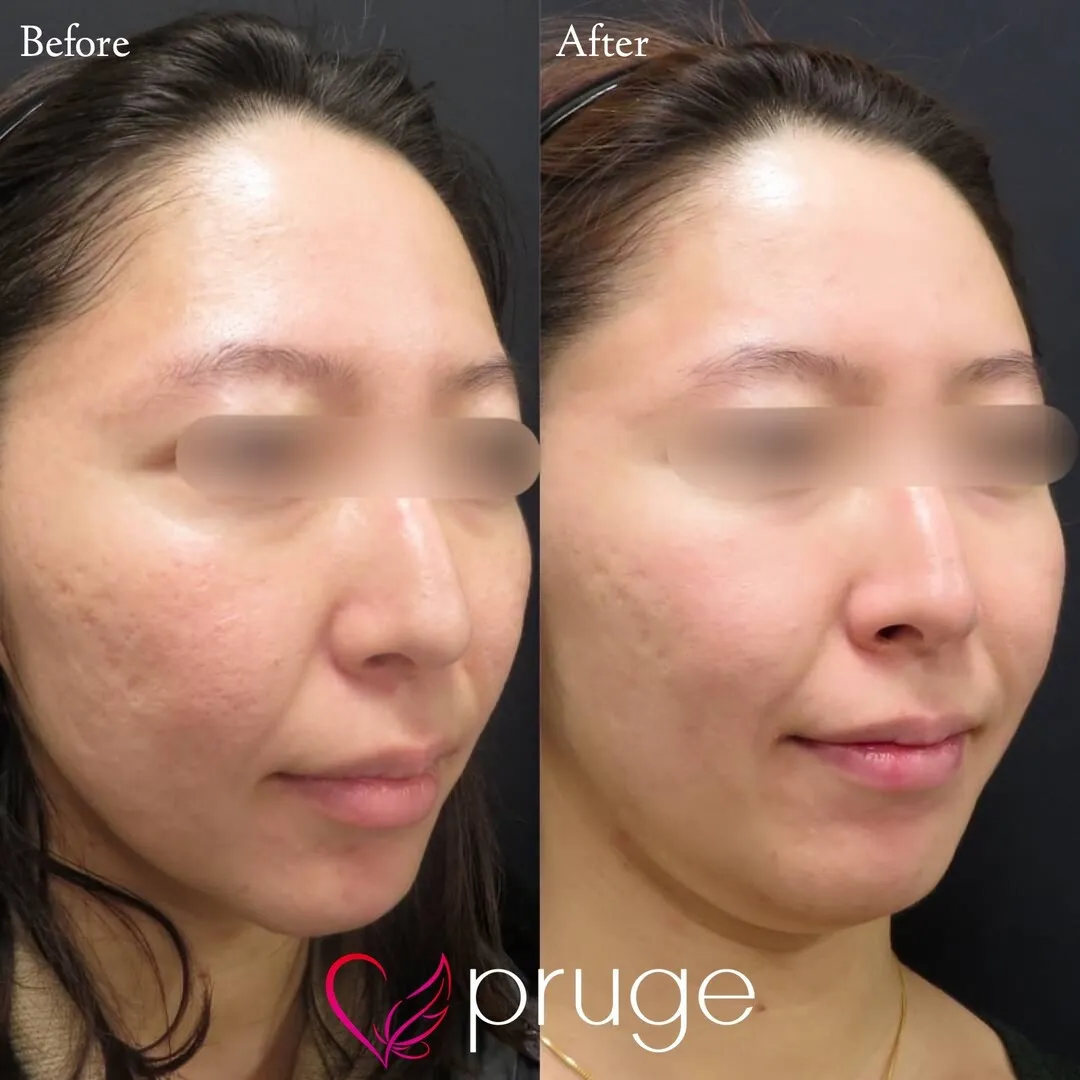 ヴァンパイアフェイシャル（全顔）