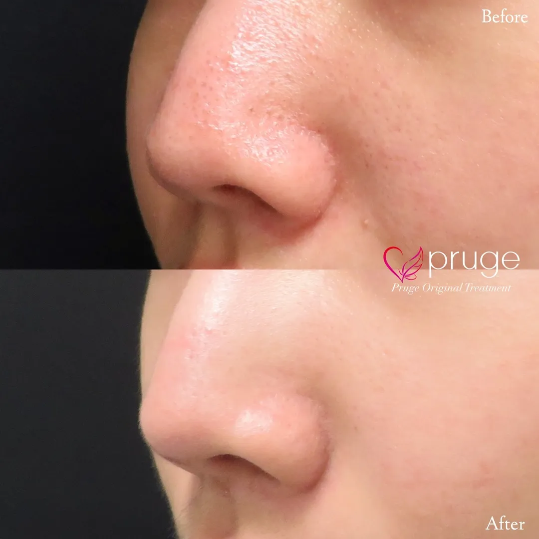 ヴァンパイアフェイシャル（鼻）