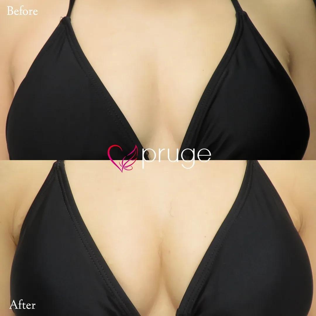 PRP注射（お胸）