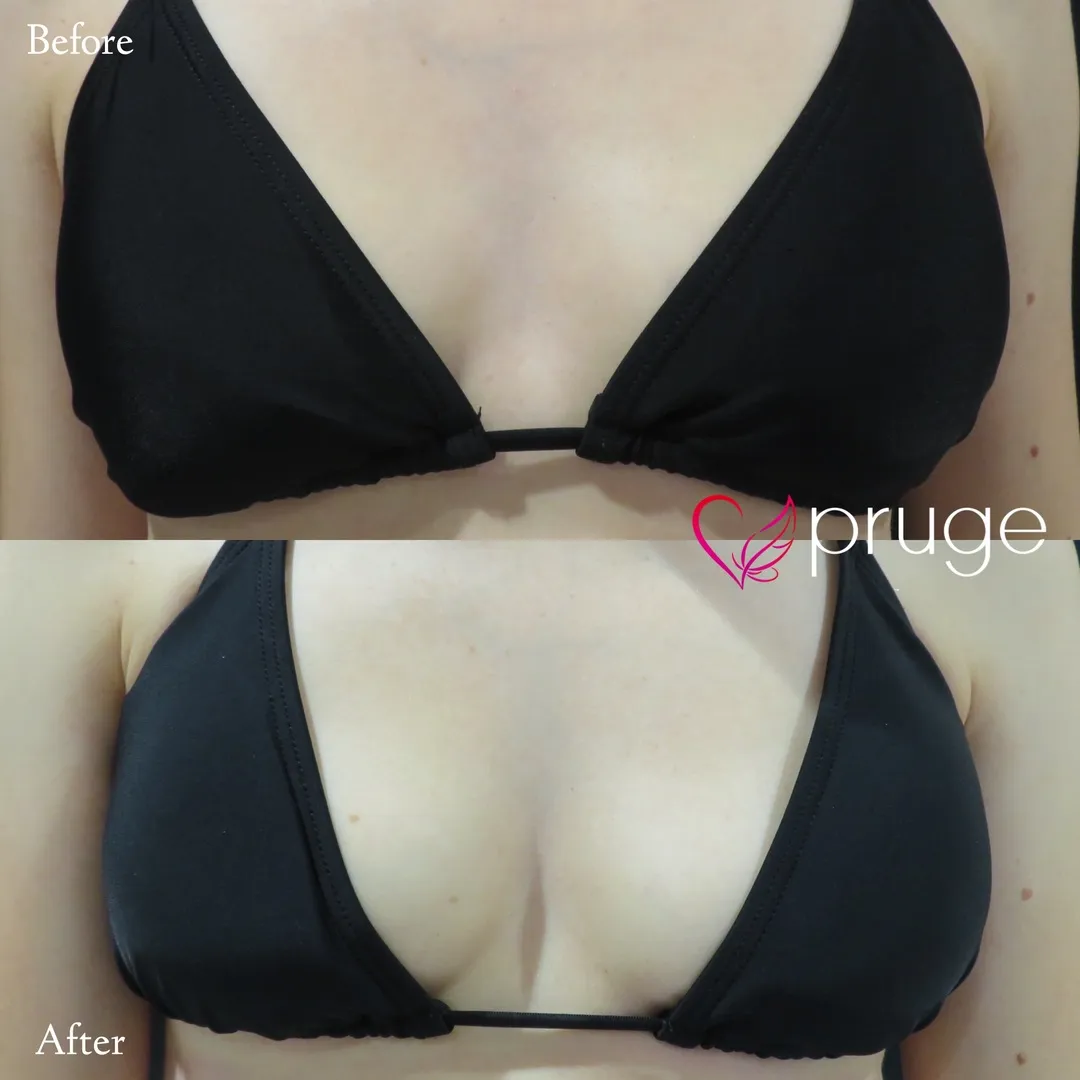 PRP注射（お胸）