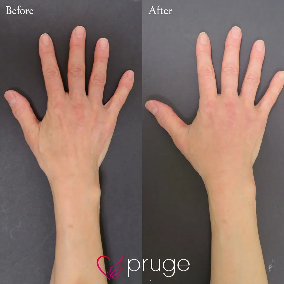 手の甲のスジ・血管