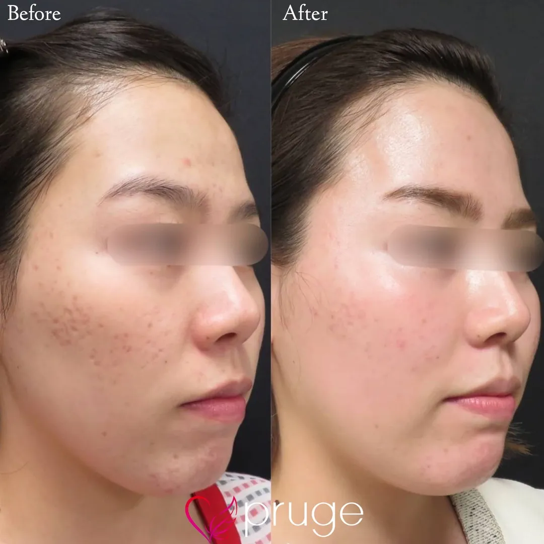 ヴァンパイアフェイシャル（全顔）