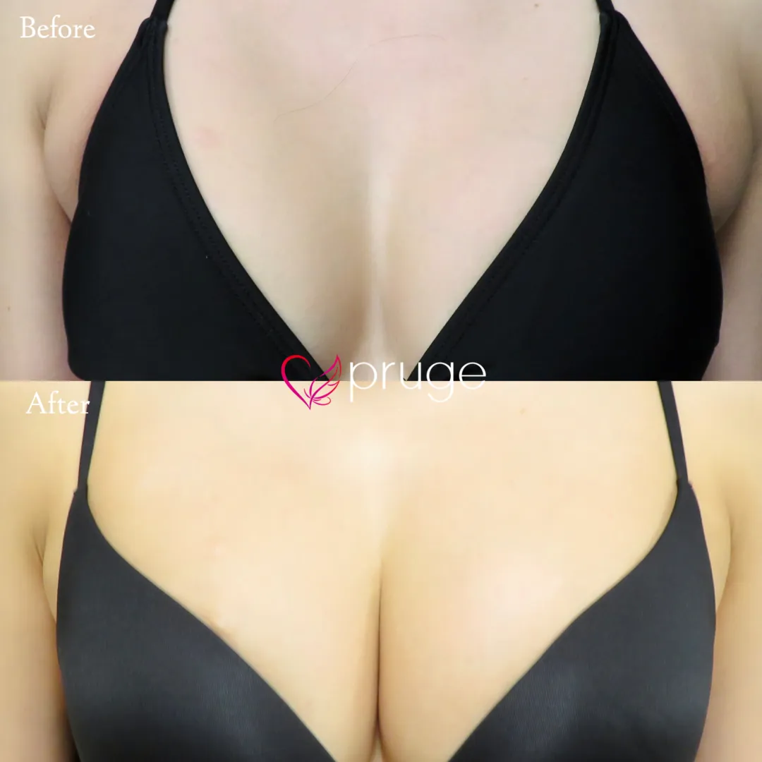 PRP注射（お胸）