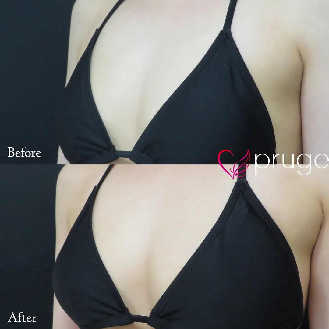 PRP注射（お胸）