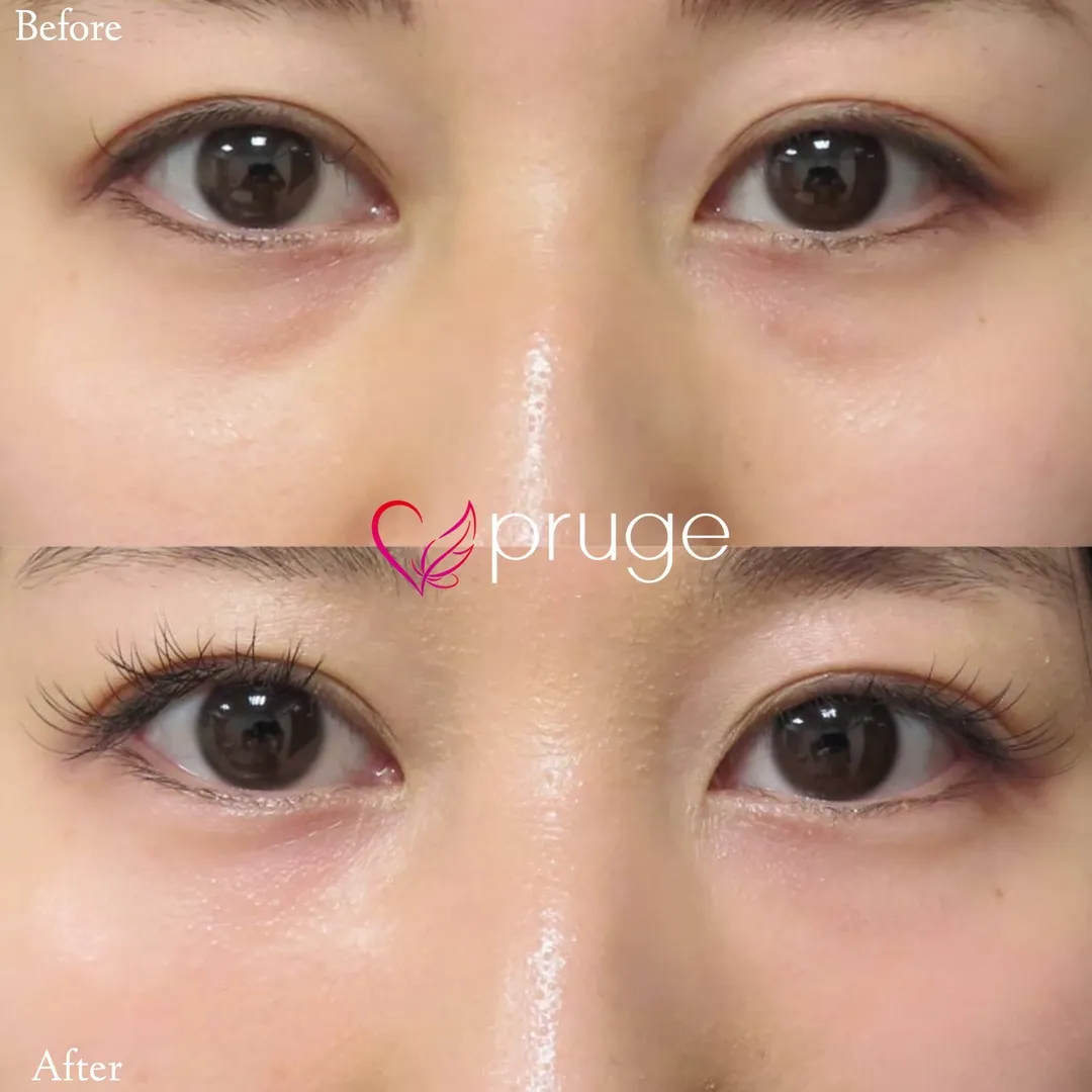 目の下のクマ・色素沈着