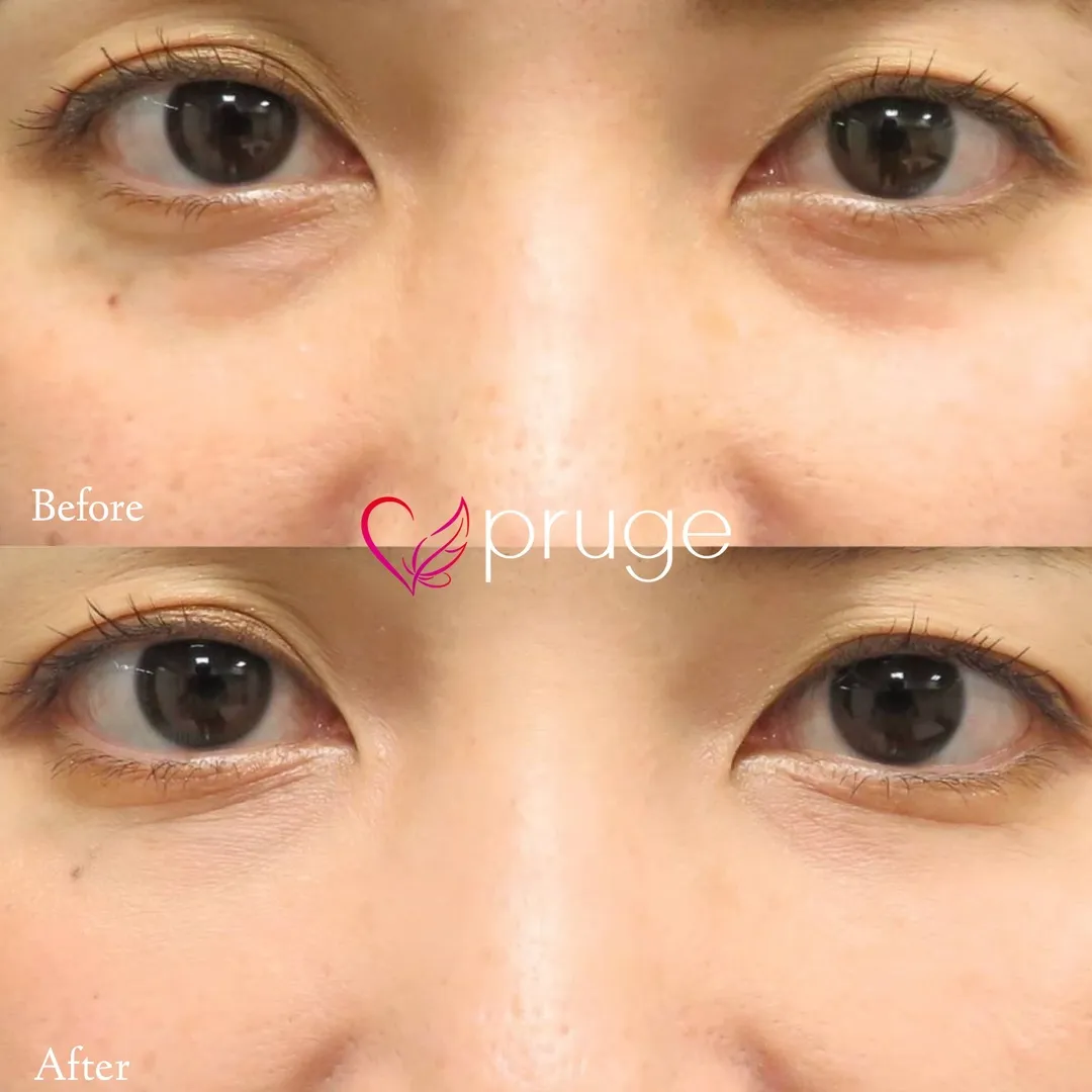 目の下のクマ・凹み