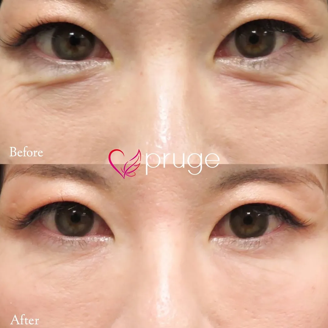 目の下のクマ・小じわ