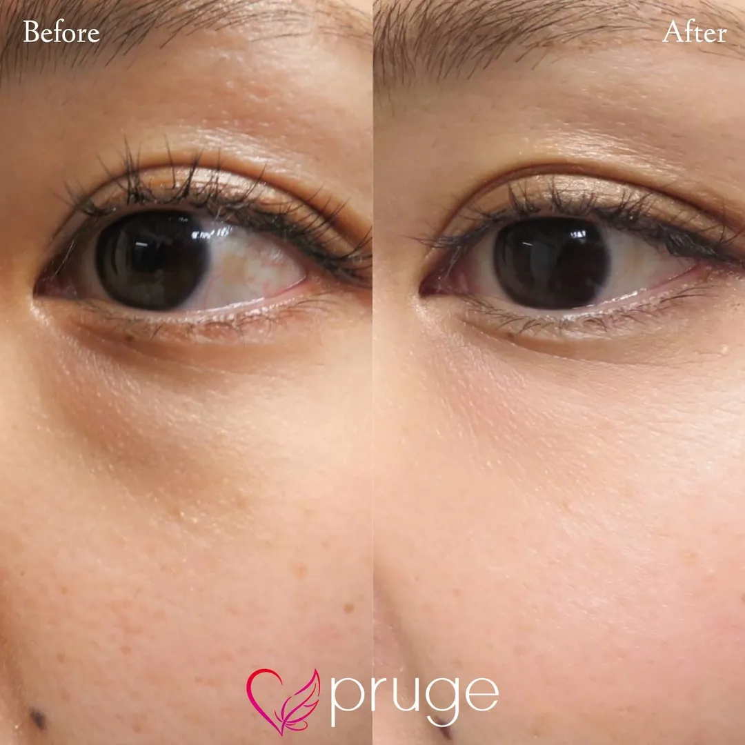 目の下のクマ・色素沈着