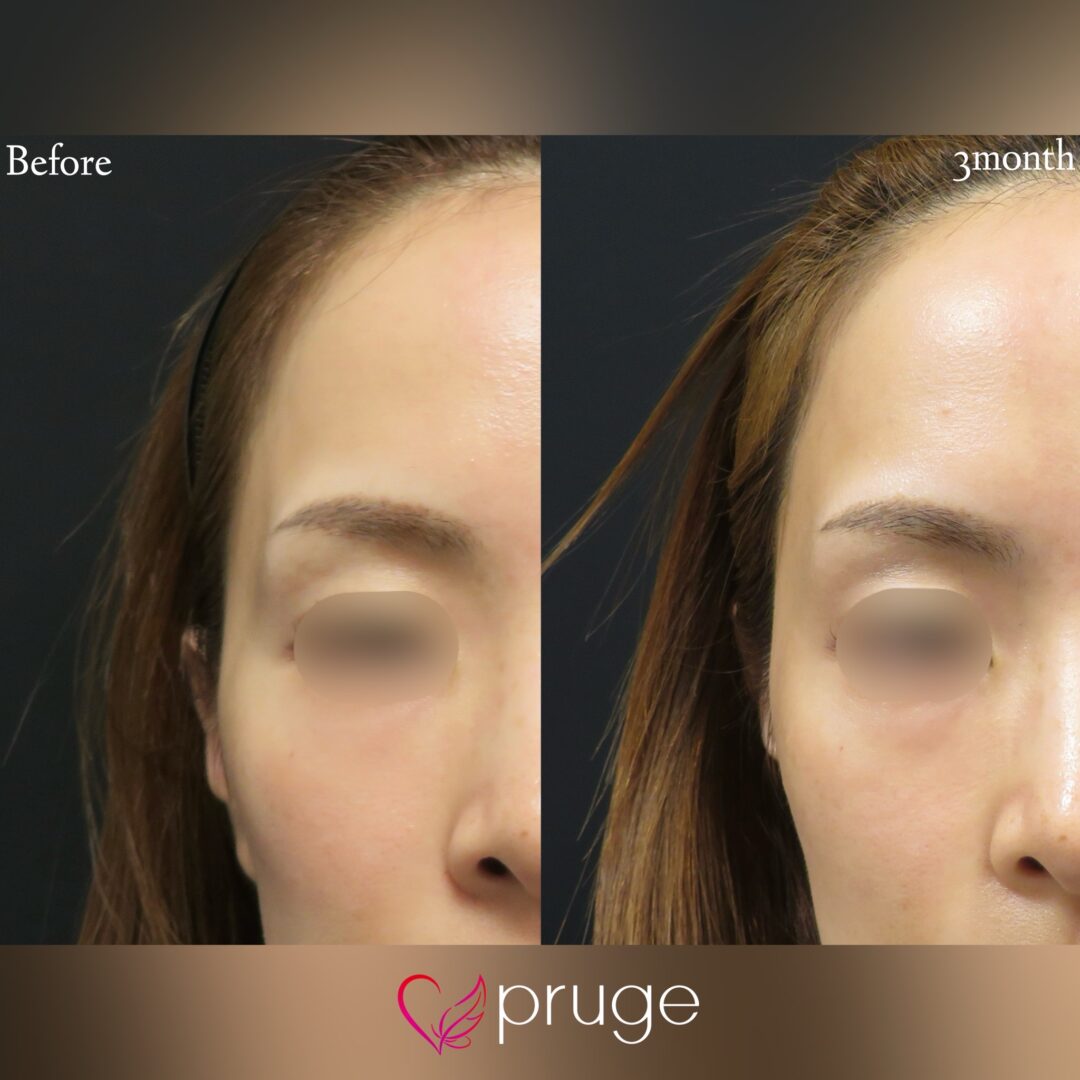 PRP注射(こめかみ凹み)