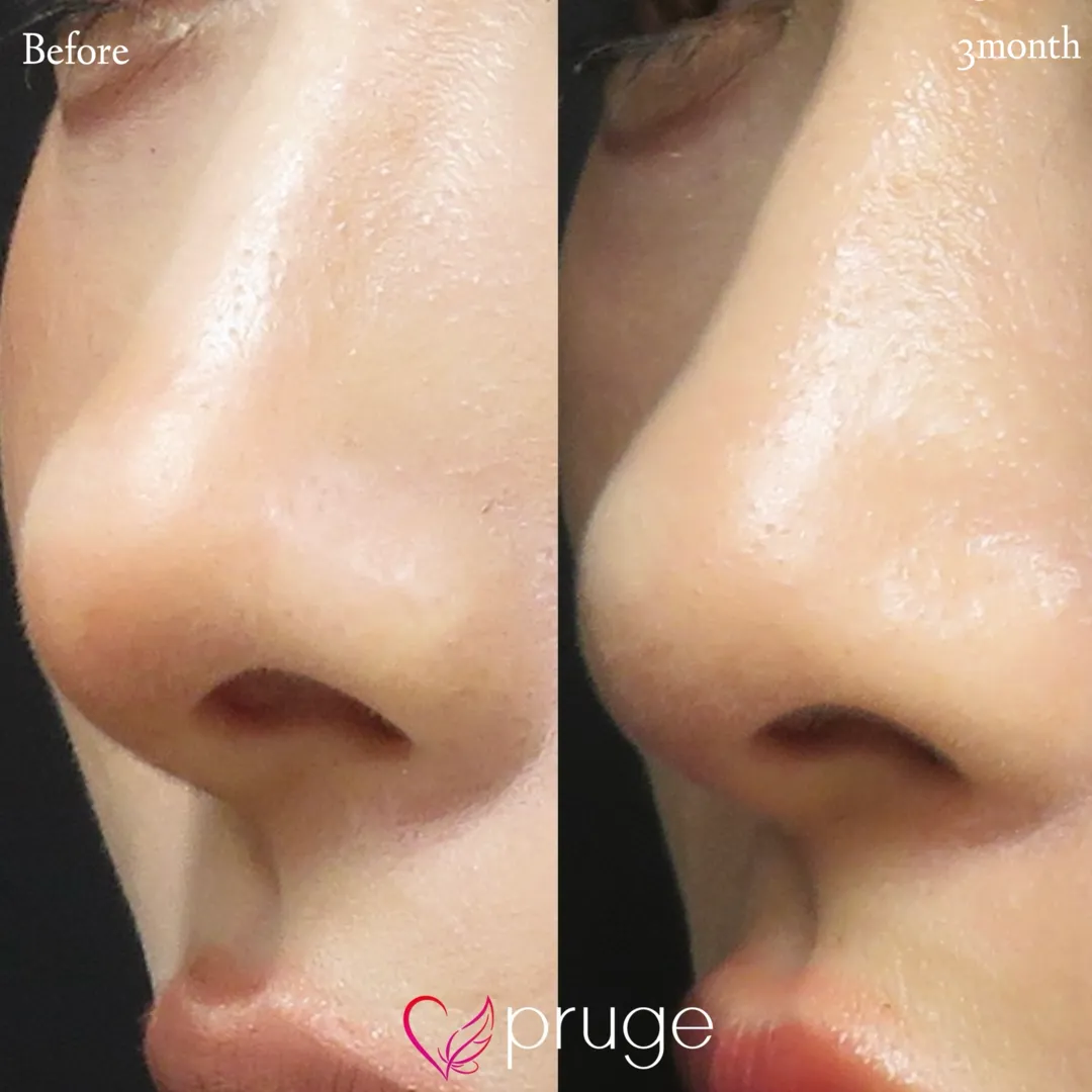 PRP注射(鼻孔下縁)