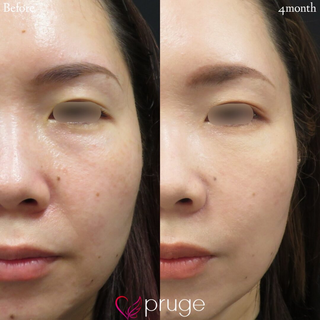 PRP注射（目の下·法令線）