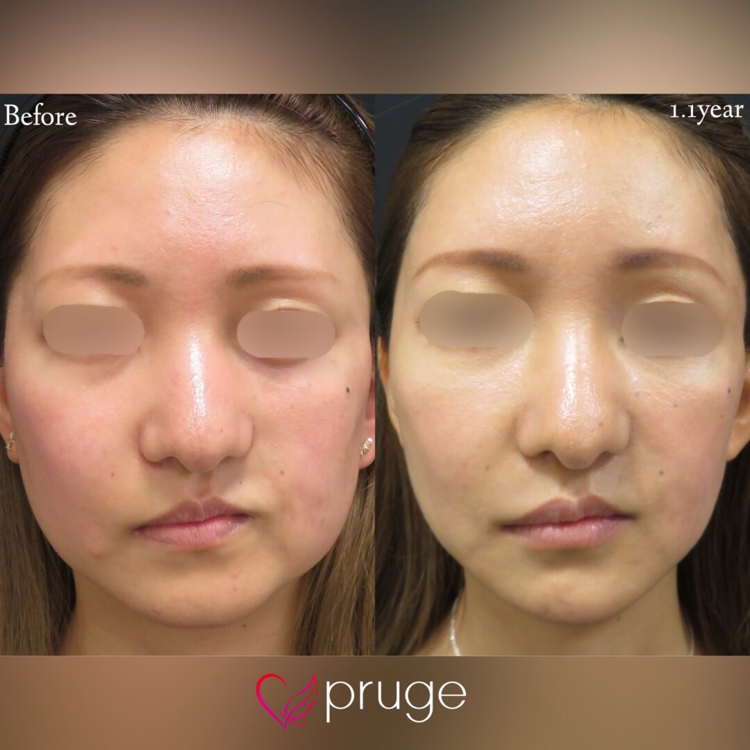 ロンバーグ病に対するPRP注射