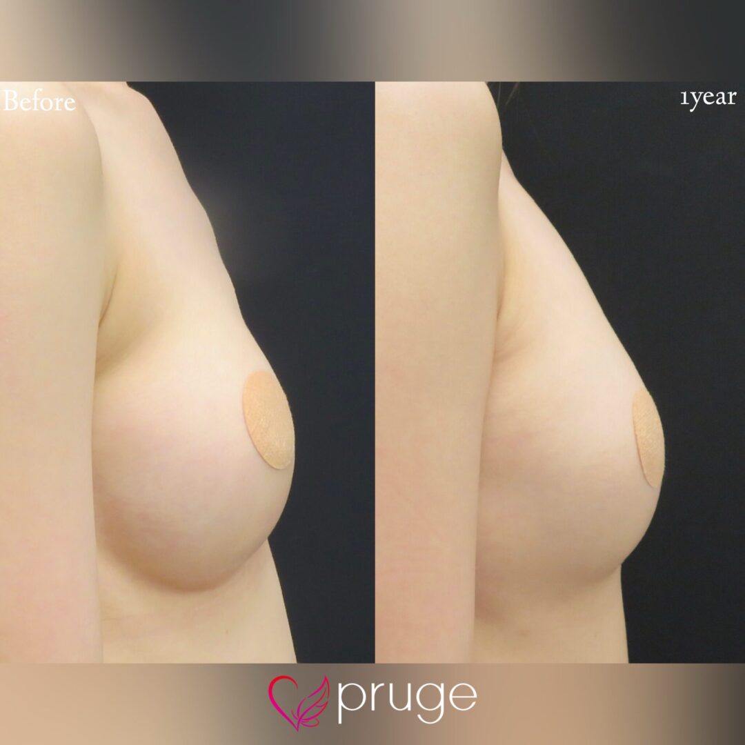 シリコンバッグ後修正