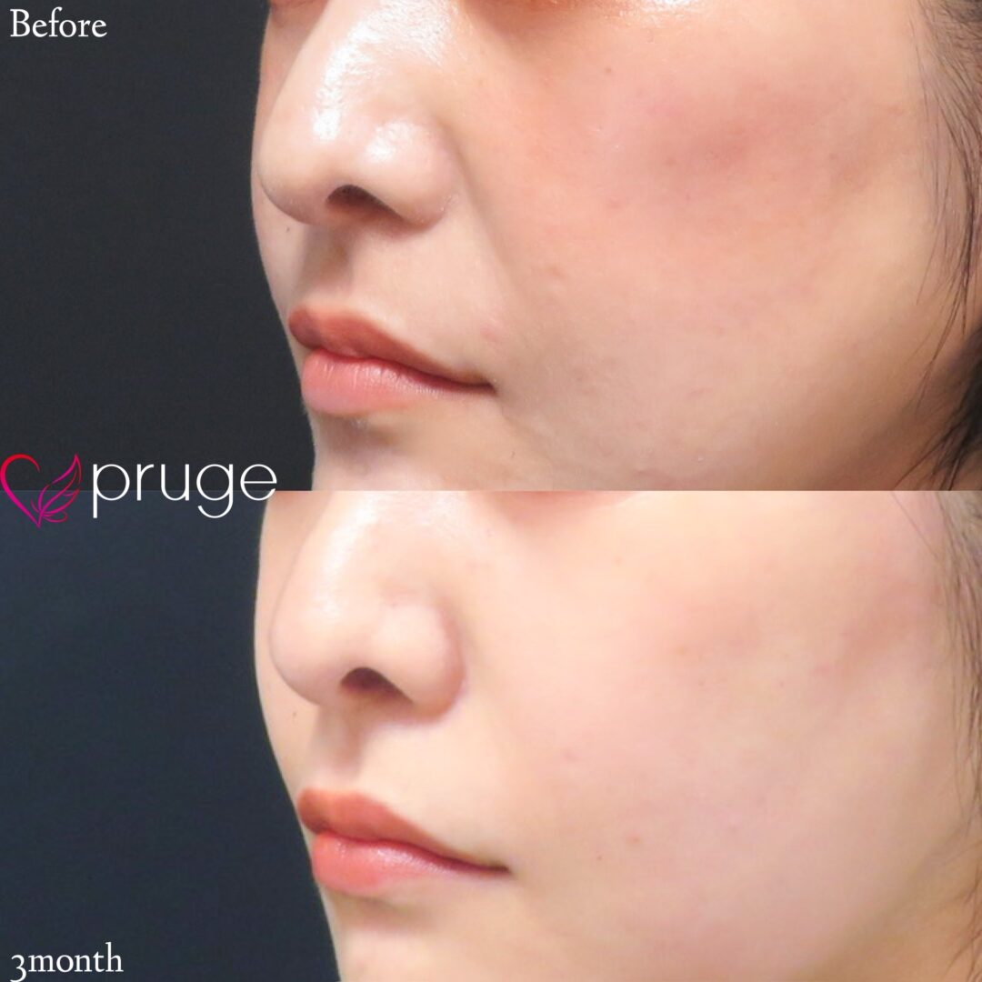 PRP注射（法令線）