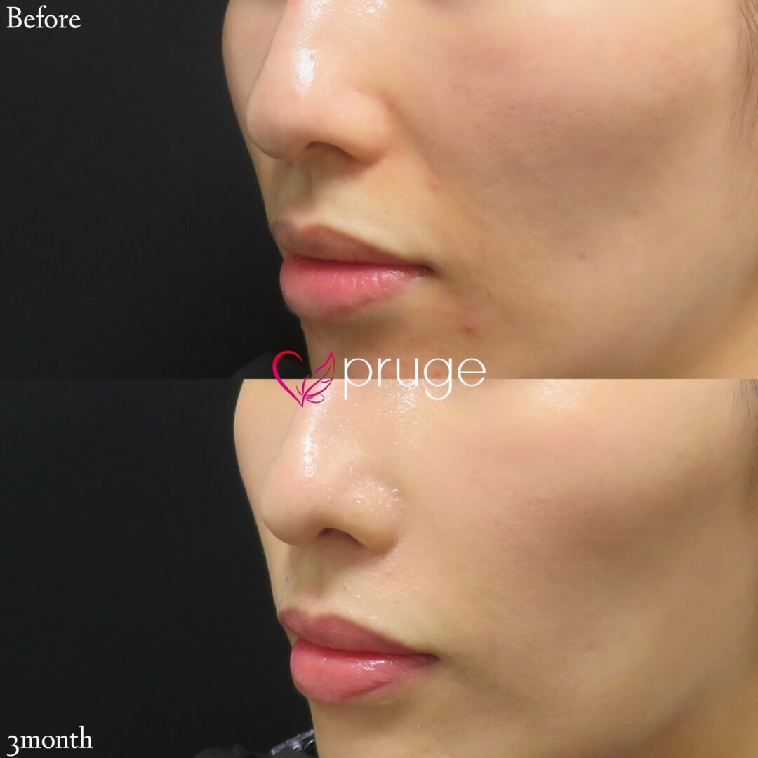 PRP注射（法令線）