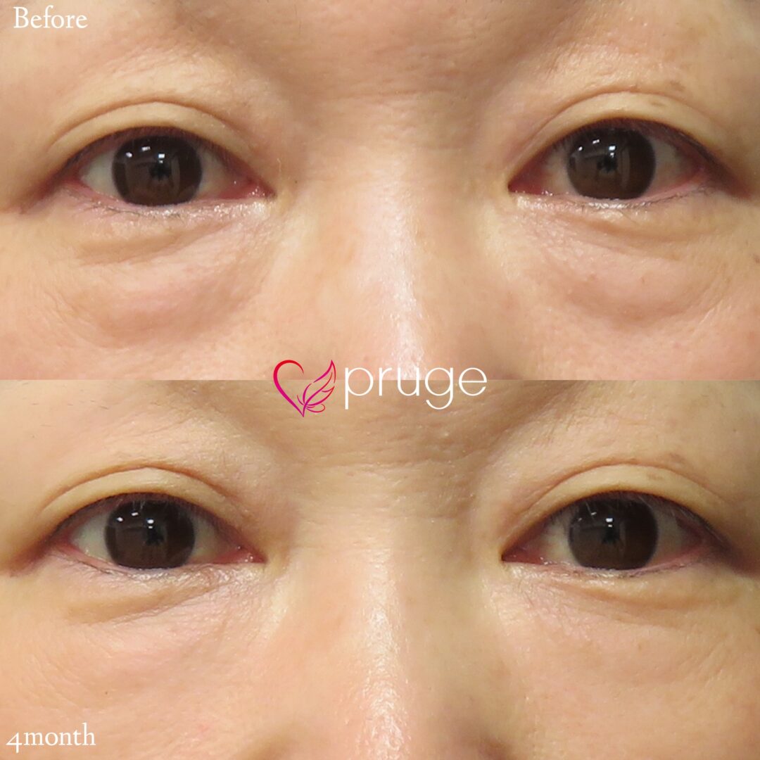 PRP注射（目の下）