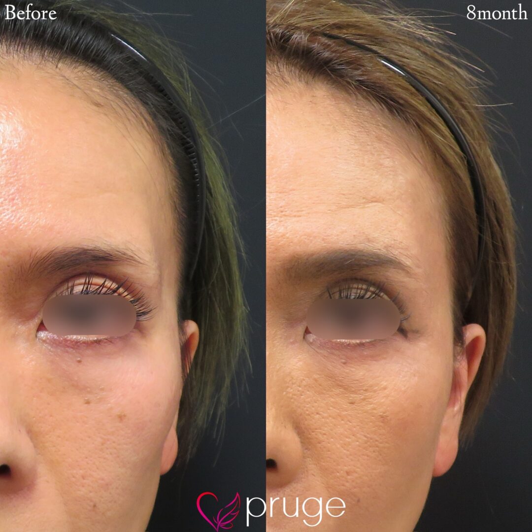 PRP注射（こめかみ）