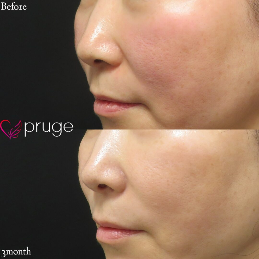 ほうれい線治療のPRP注射