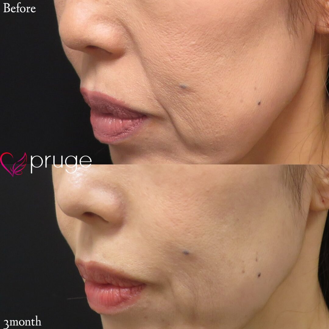 法令線治療のPRP注射