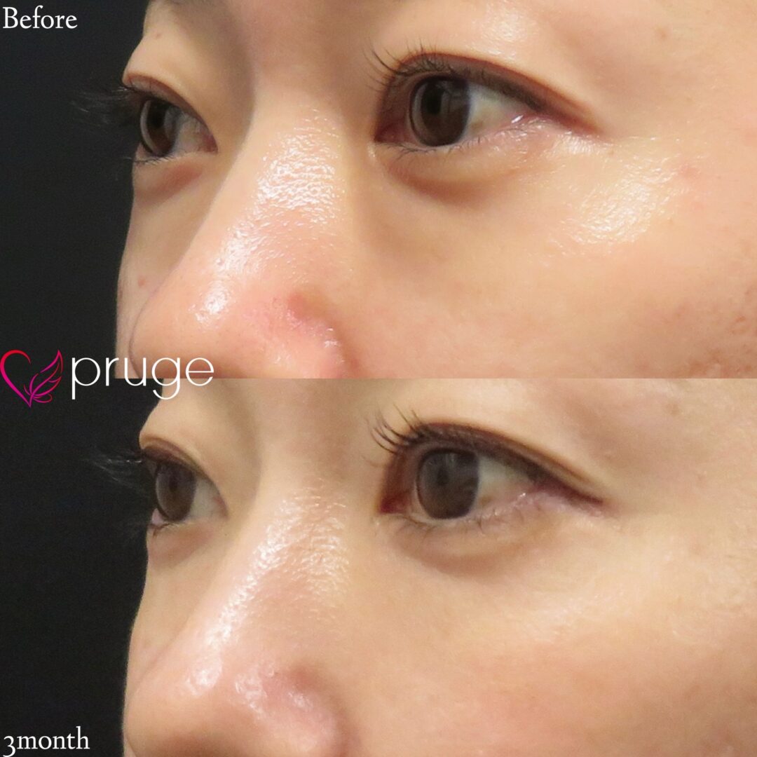 PRP注射（目の下）