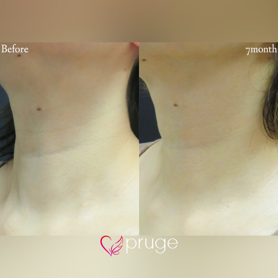 【PRP注射（首）】