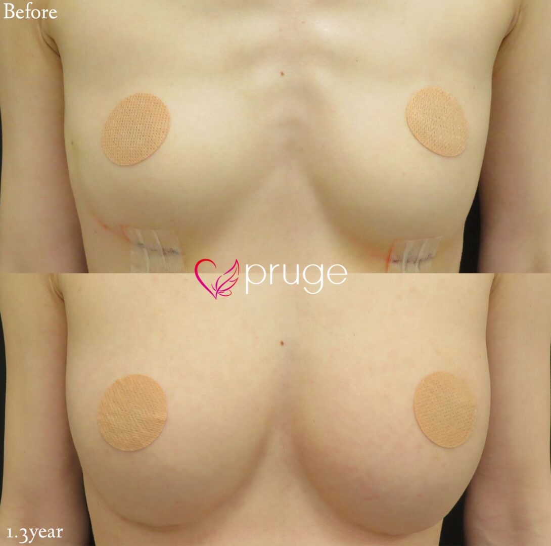 PRP注射によるバストアップ