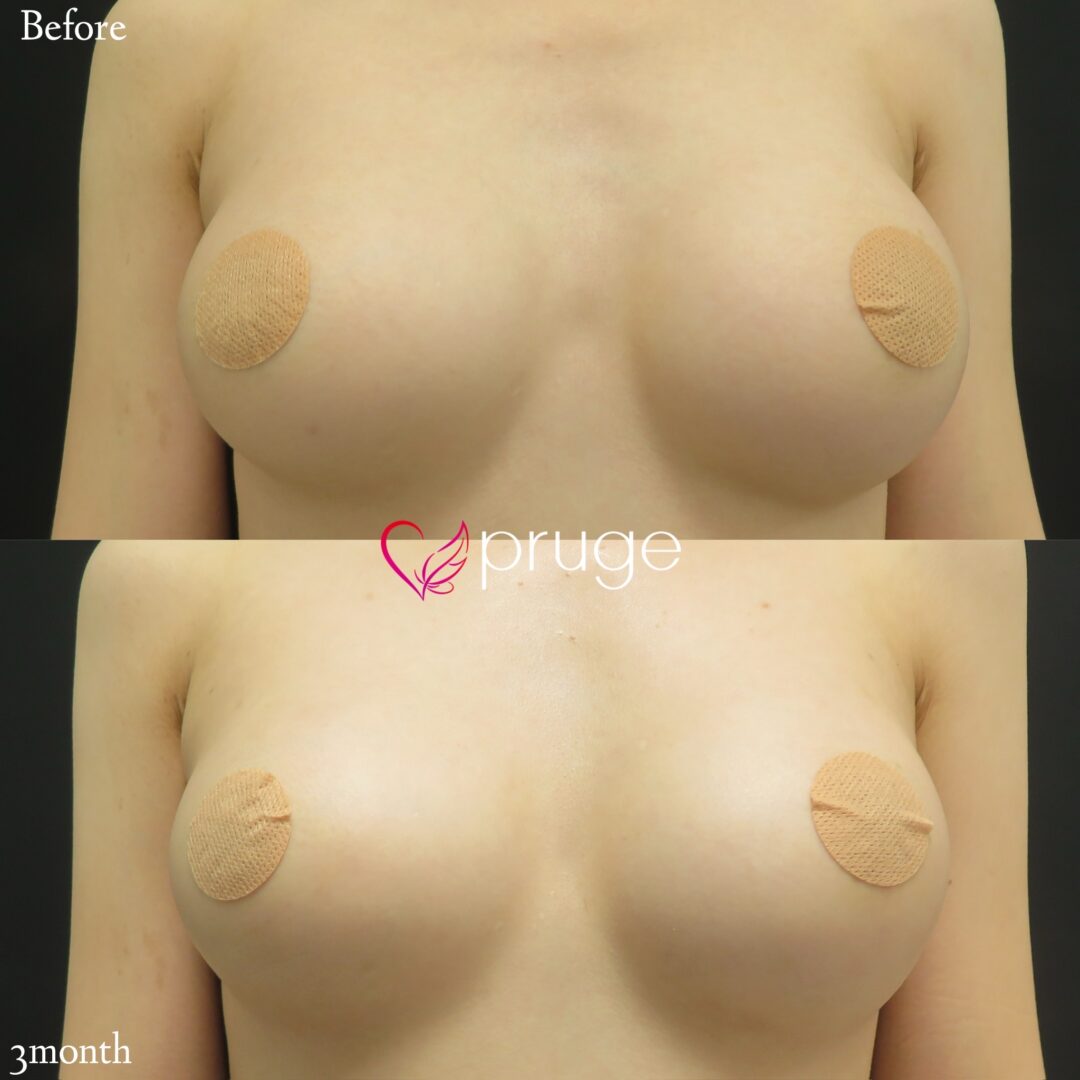 PRP注射によるシリコンバッグ豊胸修正
