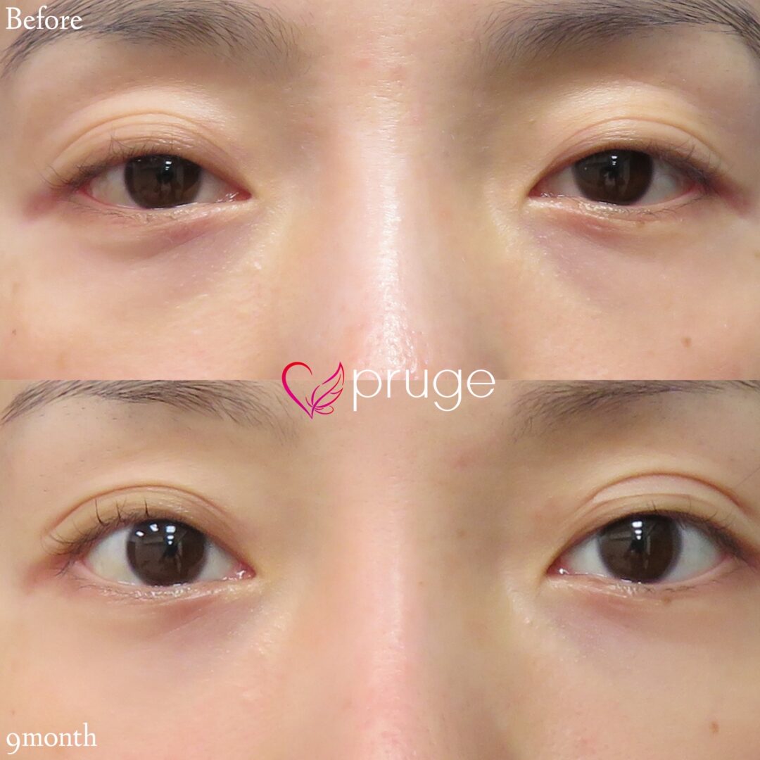 【PRP注射:目の下】