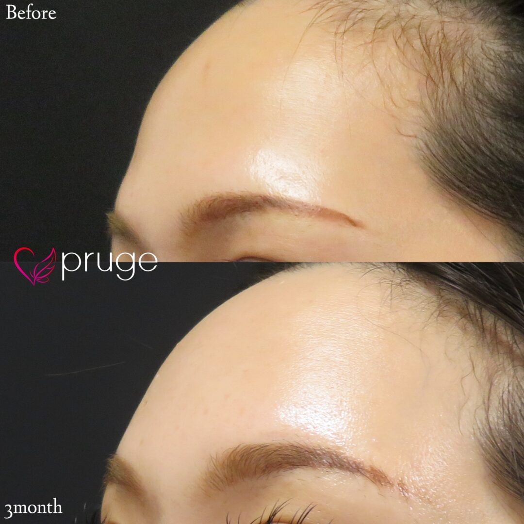 おでこのPRP注射