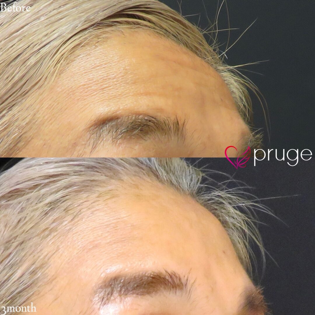 PRP注射　額のシワ