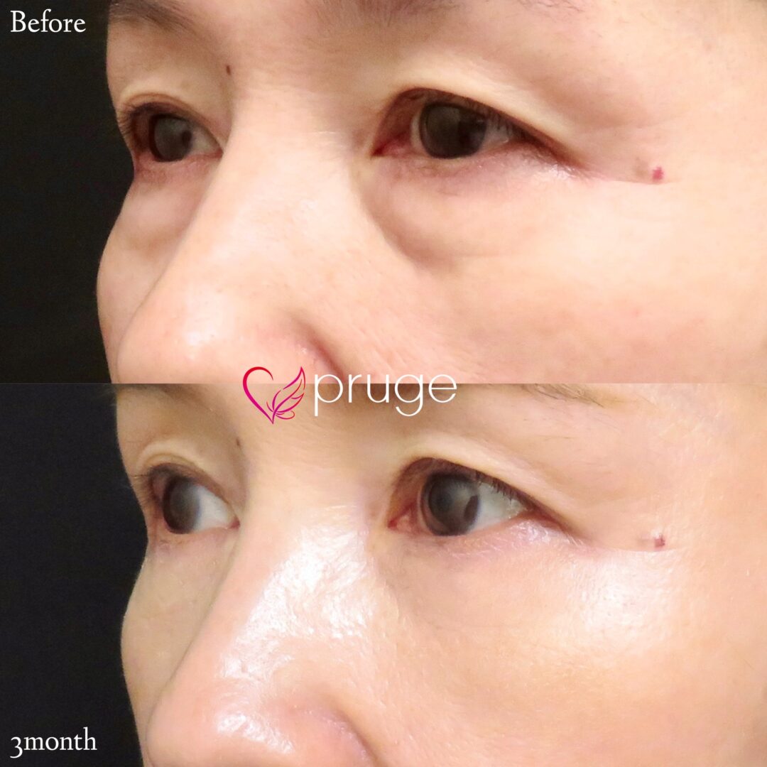 PRP-MI脱脂術＋PRP注射(目尻)