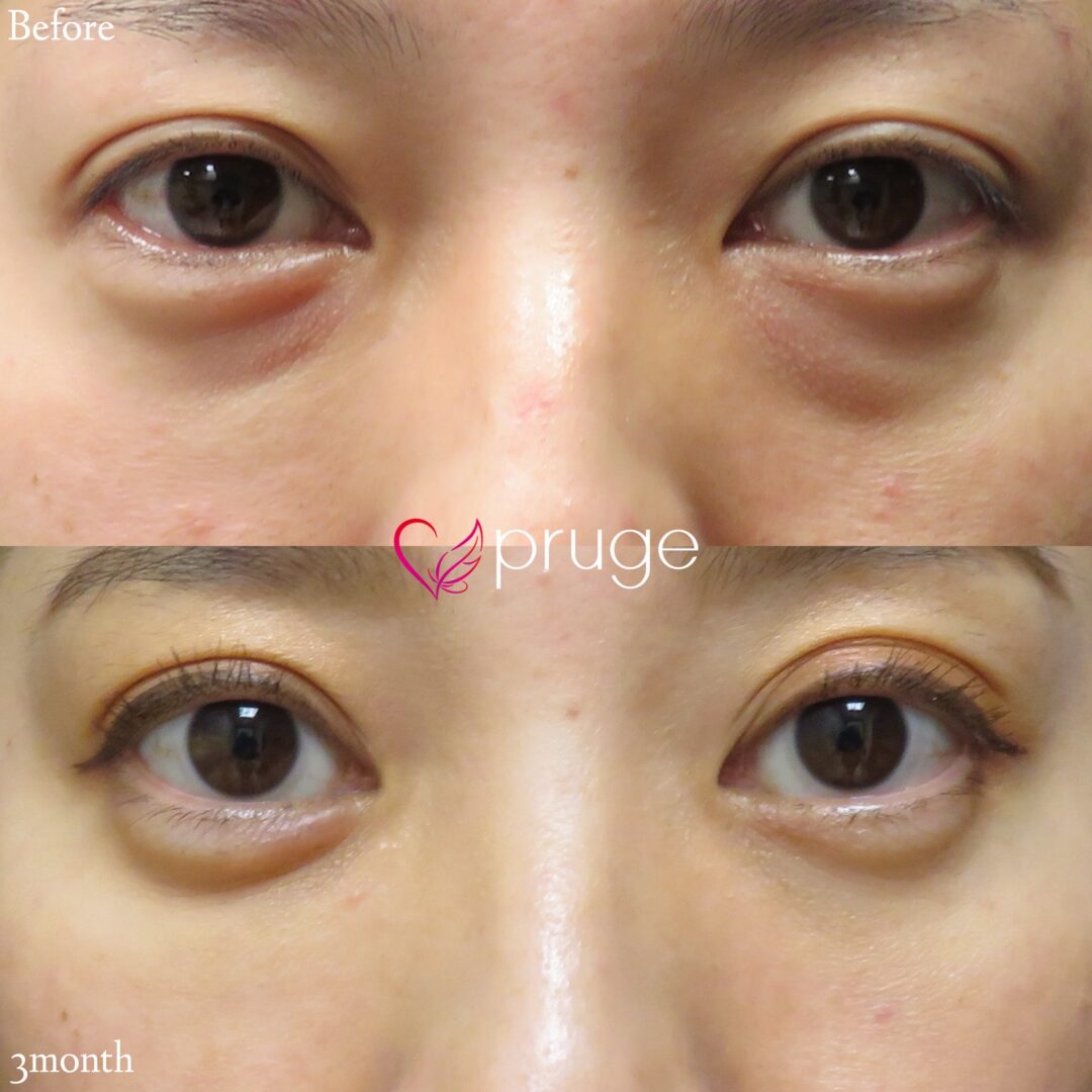 【PRP-MI脱脂術】