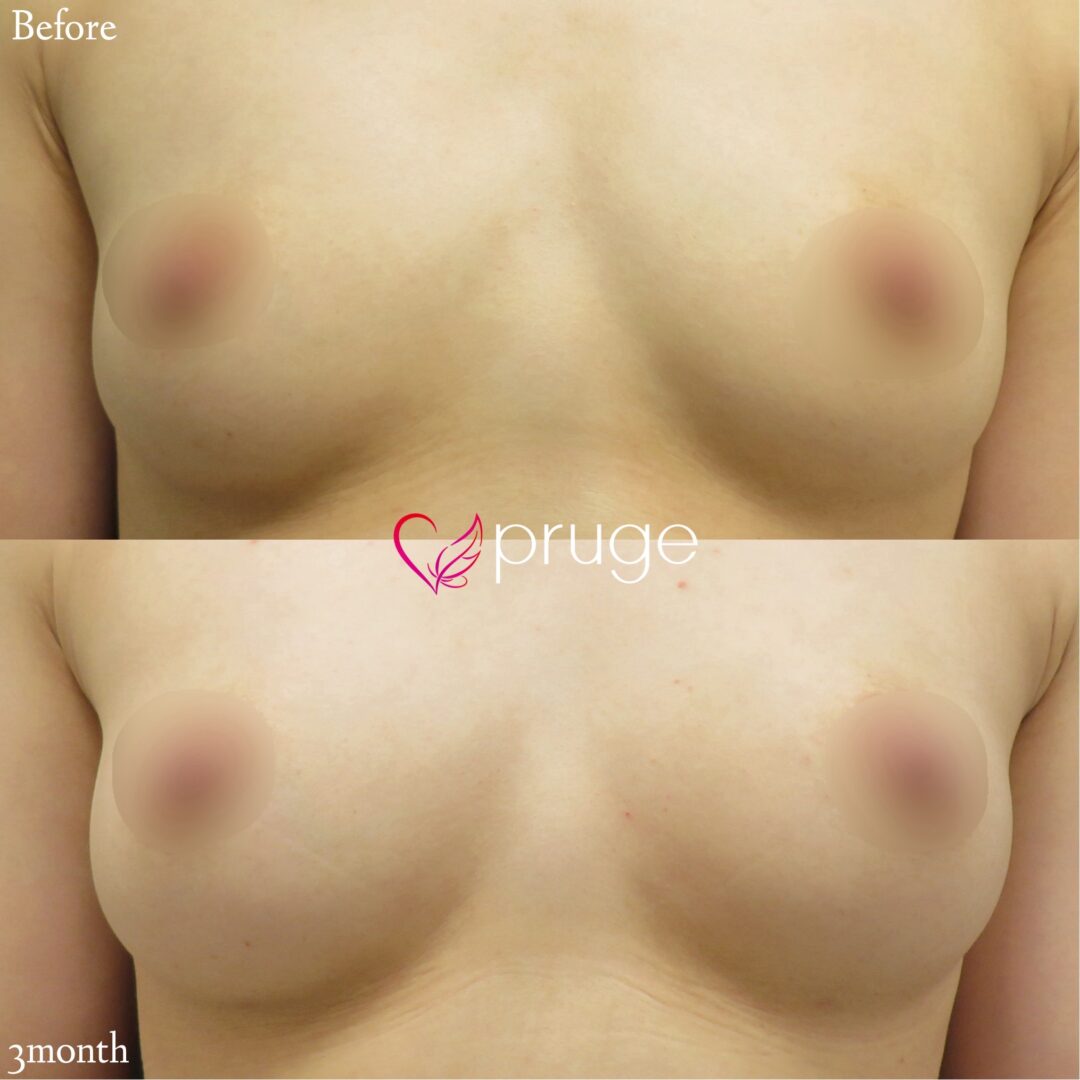 PRP注射によるバストアップ