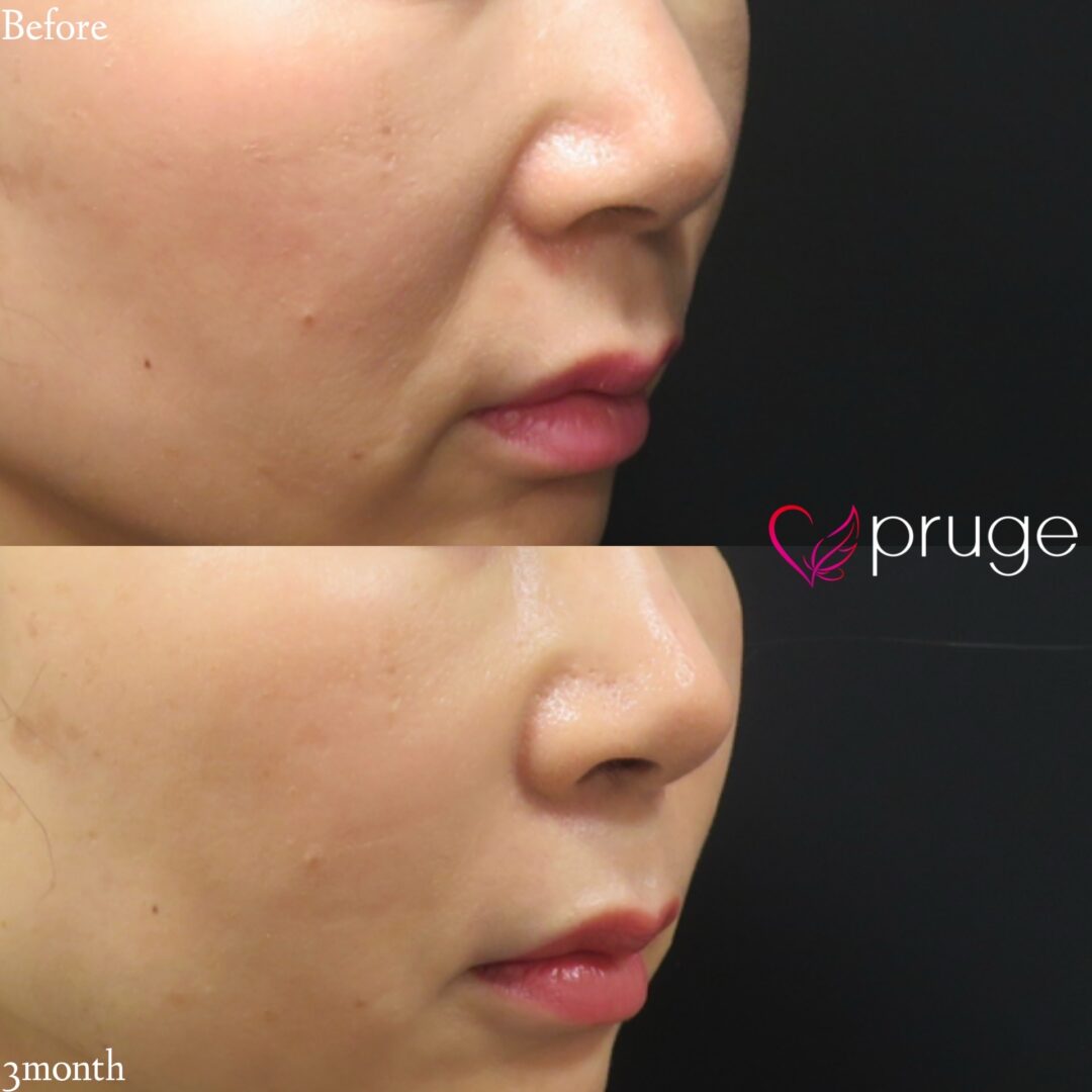 PRP注射(法令線)