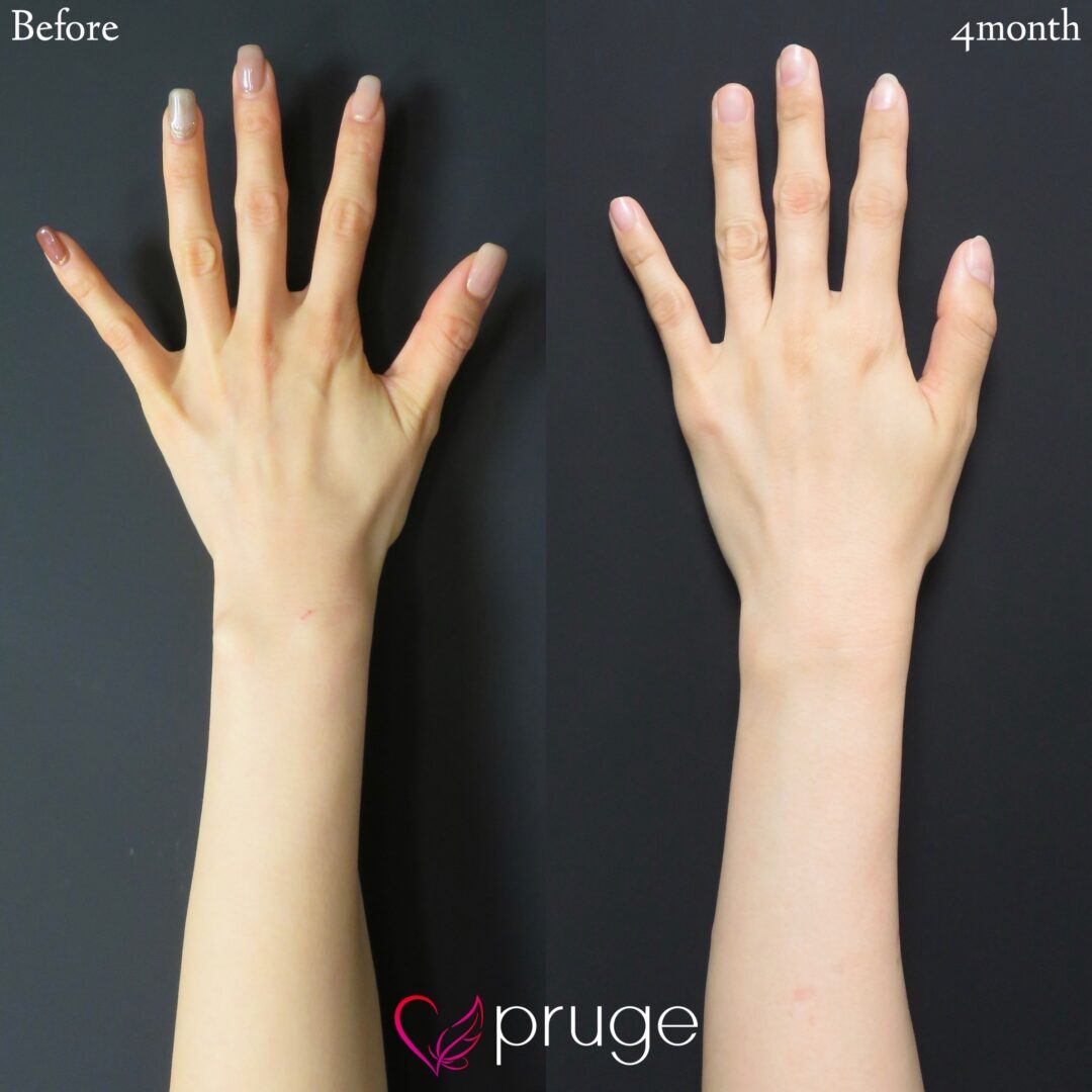 PRP注射（手の甲）