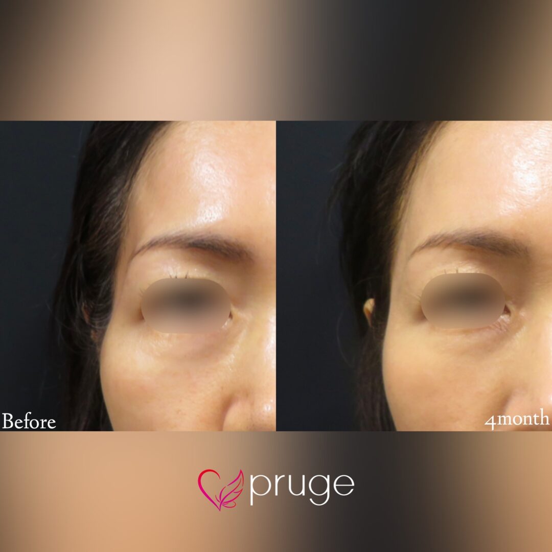 PRP注射(こめかみ凹み)