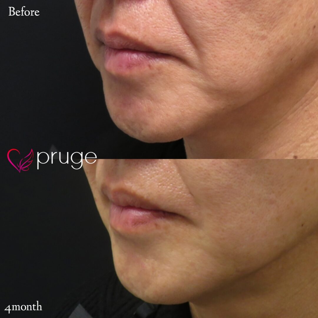 PRP注射(口元のシワ)