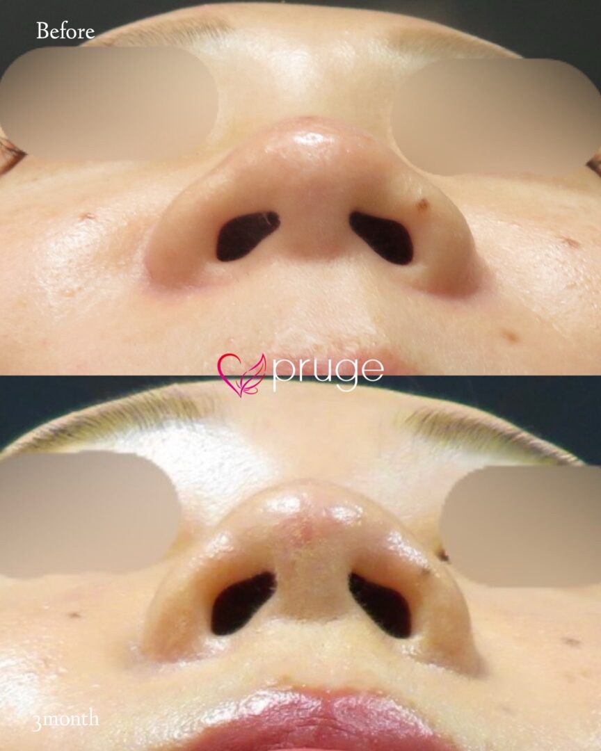 PRP注射（鼻尖）