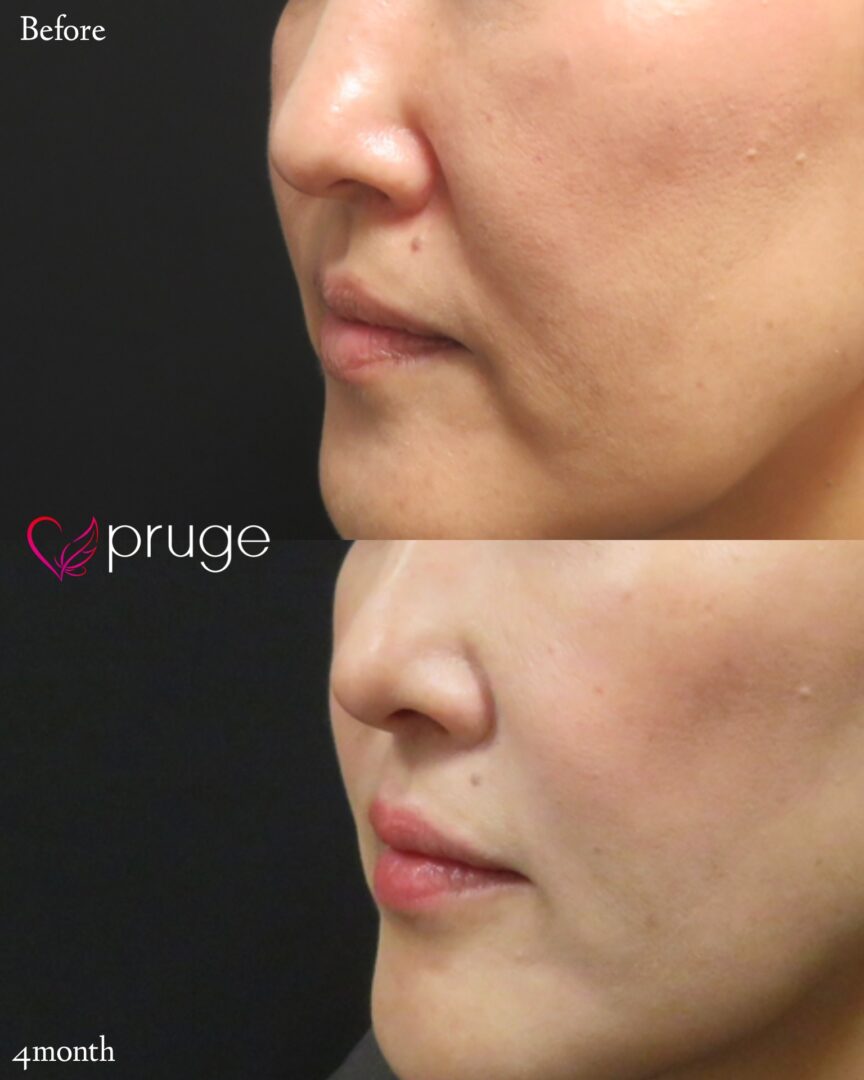 PRP注射(法令線・マリオネットライン)