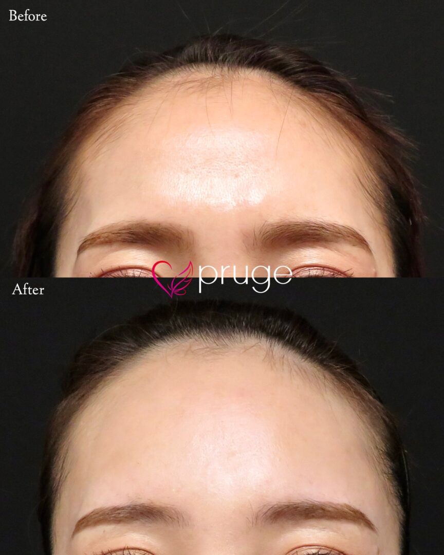 PRP注射(ひたい・こめかみ丸み形成)