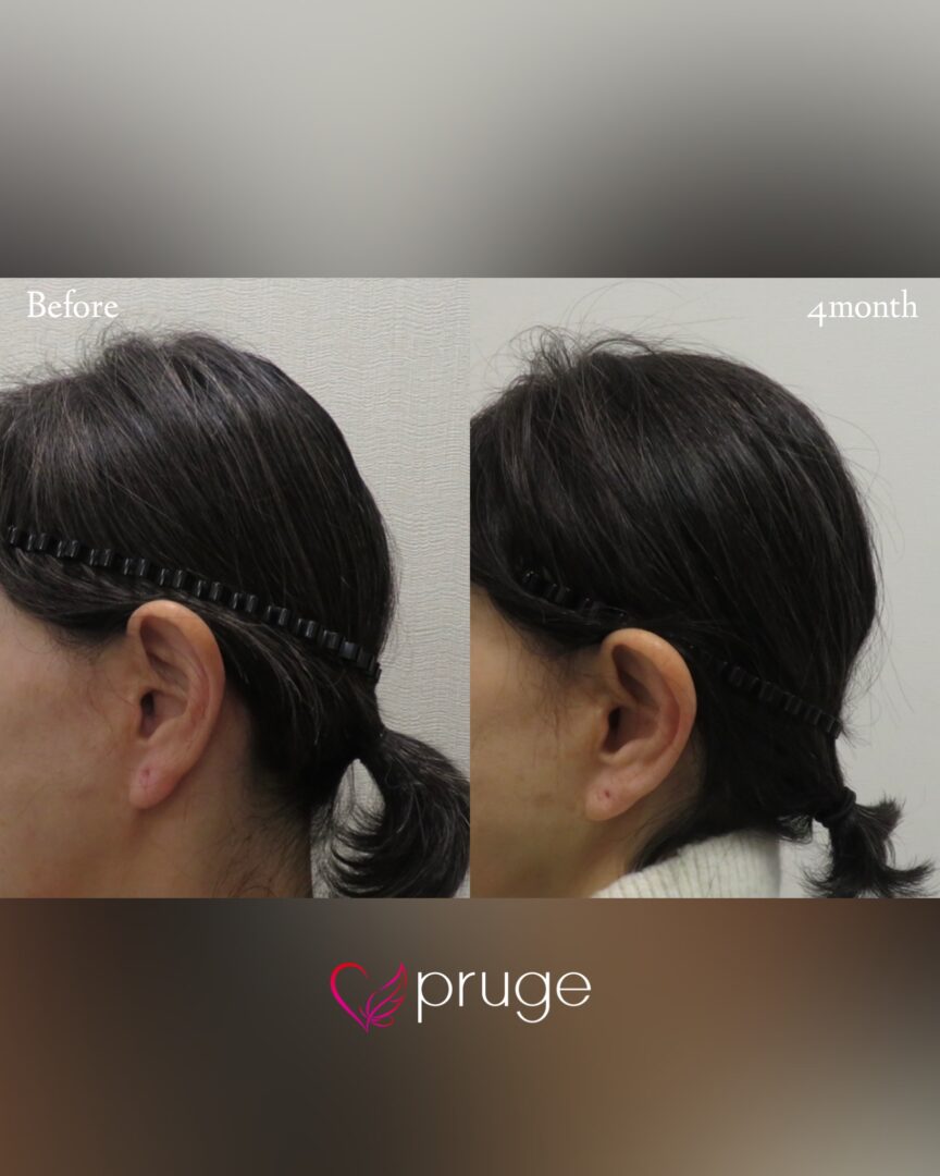 PRP注射(後頭部形成術)