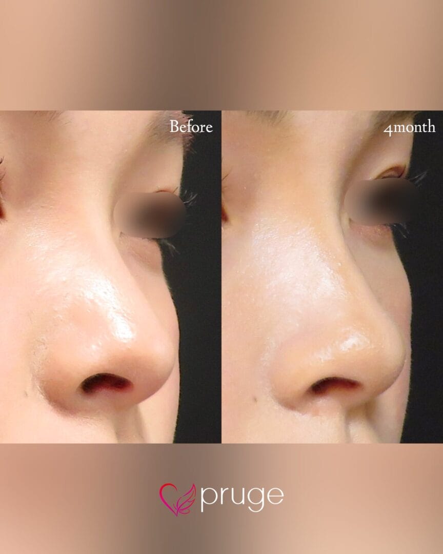 PRP注射（鼻尖・鼻根・鼻孔縁）