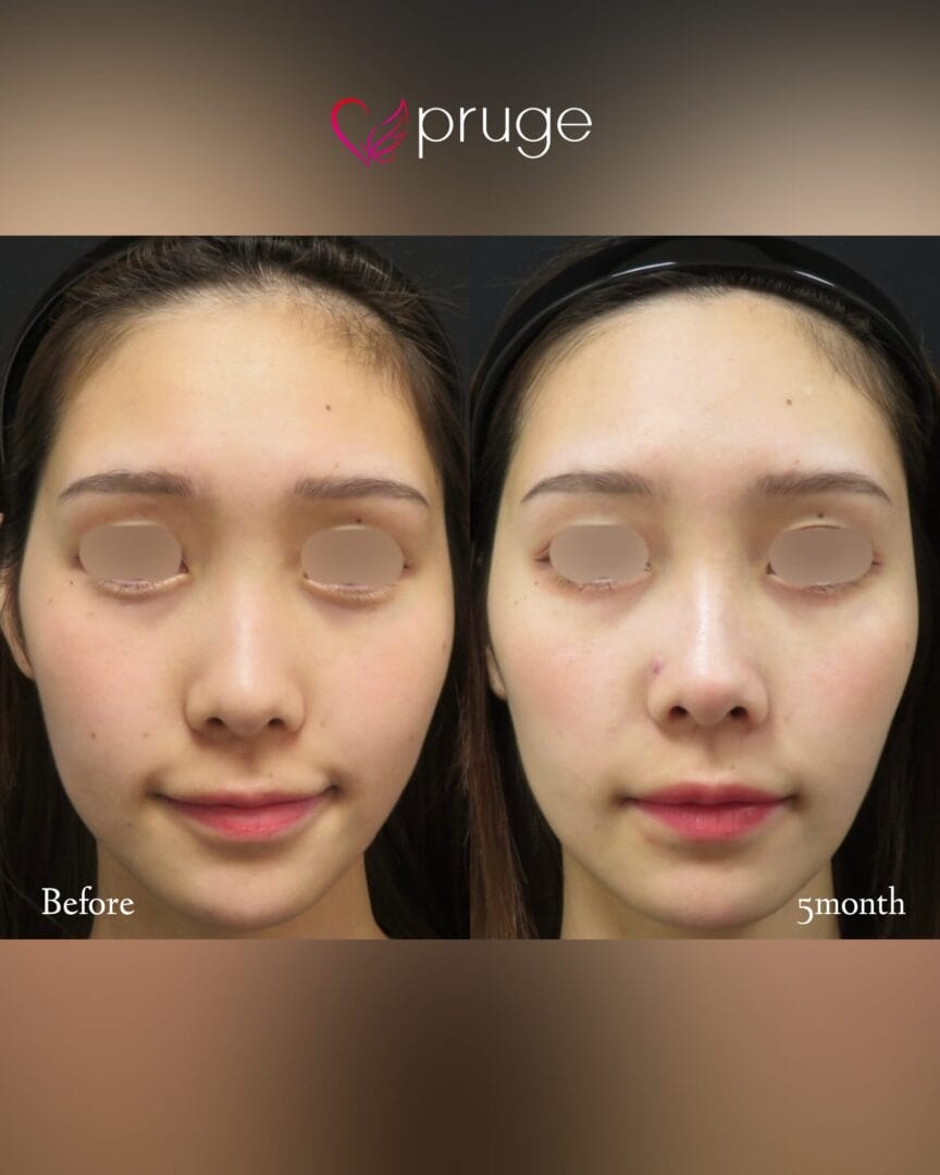 トータルPRP注射（フル）