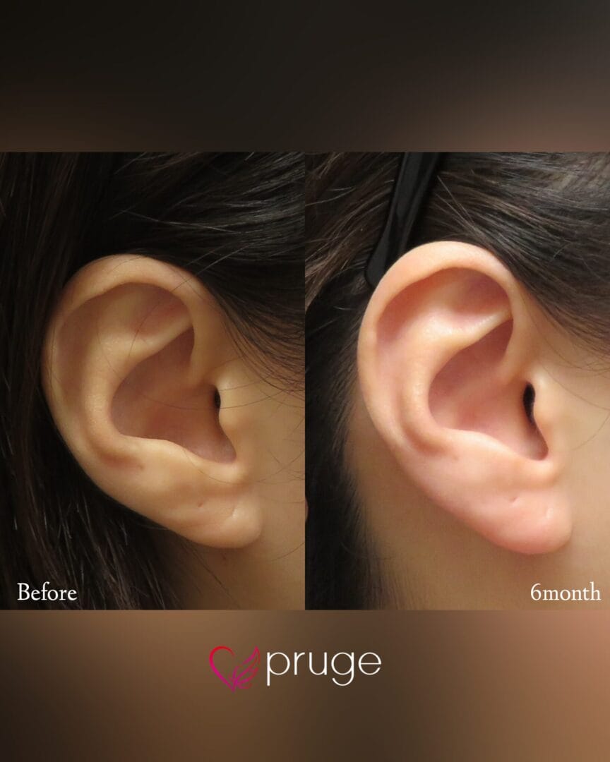 PRP注射（耳垂）