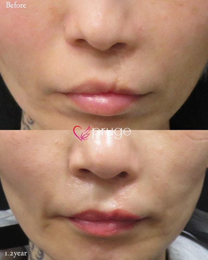 口蓋裂術後変形に対する左人中陵へのPRP注射