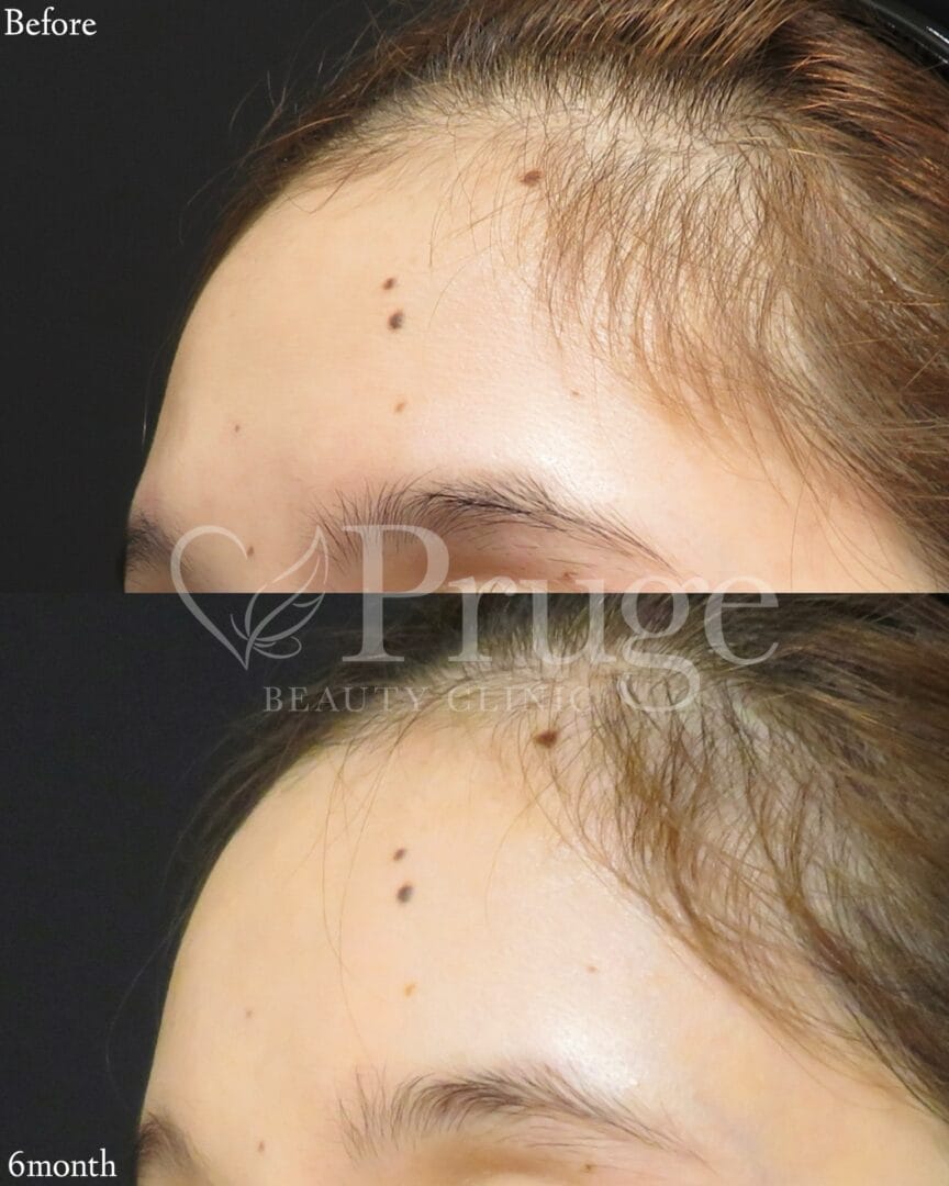 PRP注射(ひたい・こめかみ丸み形成)