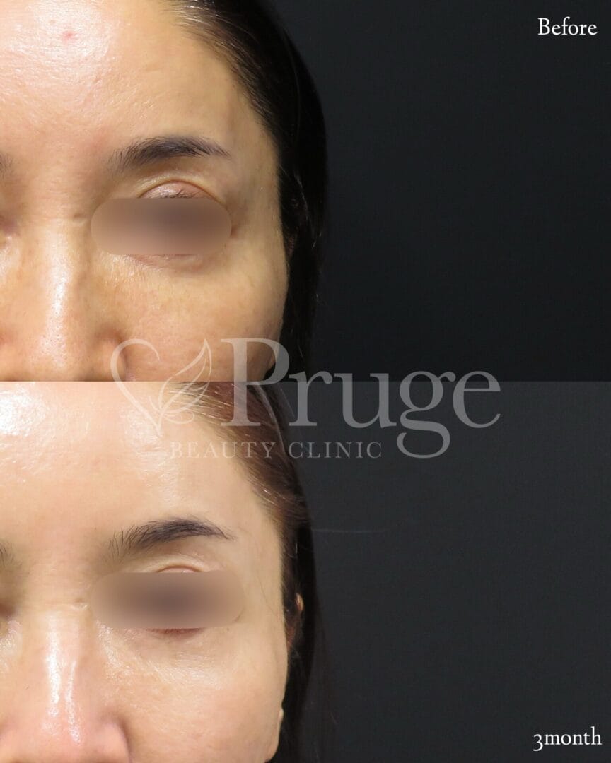 PRP注射(こめかみ凹み)