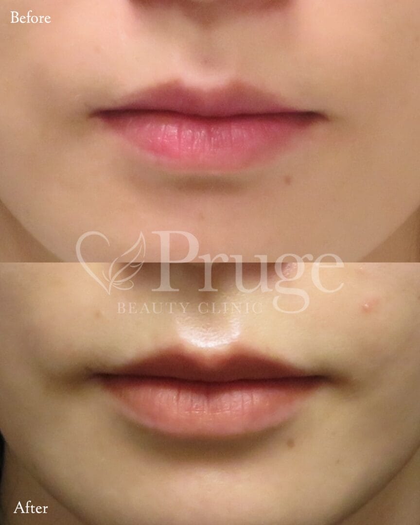 PRP注射(唇)