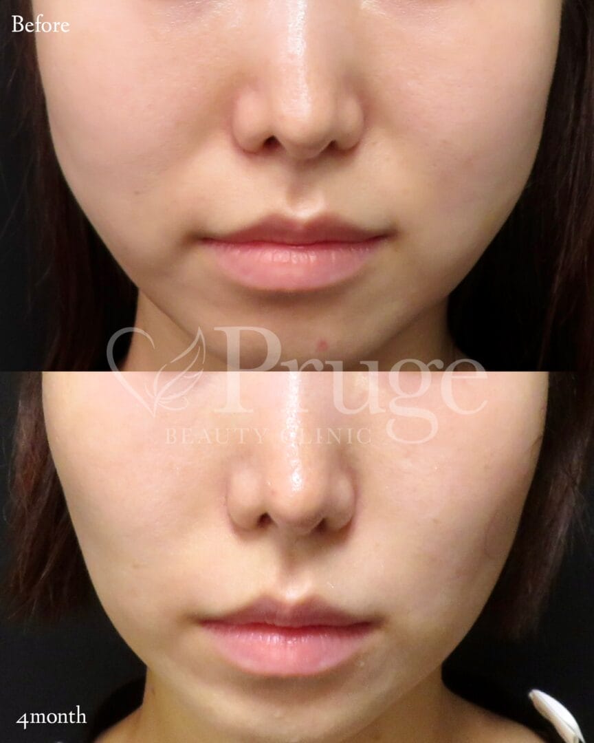 PRP注射(鼻翼基部)