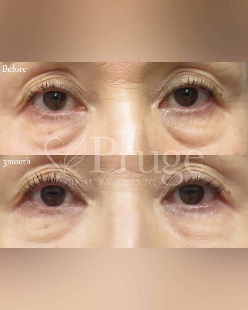 PRP注射(目の下)